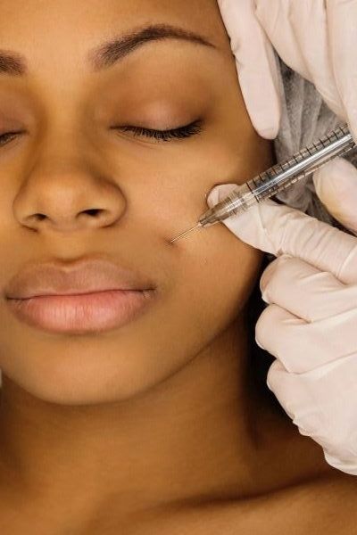 PRP Nasolabial Folds