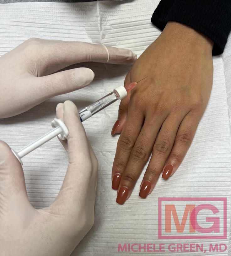 PRP Hand Rejuvenation
