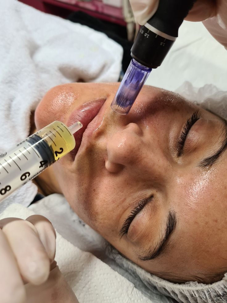 Microneedling with PRP 
